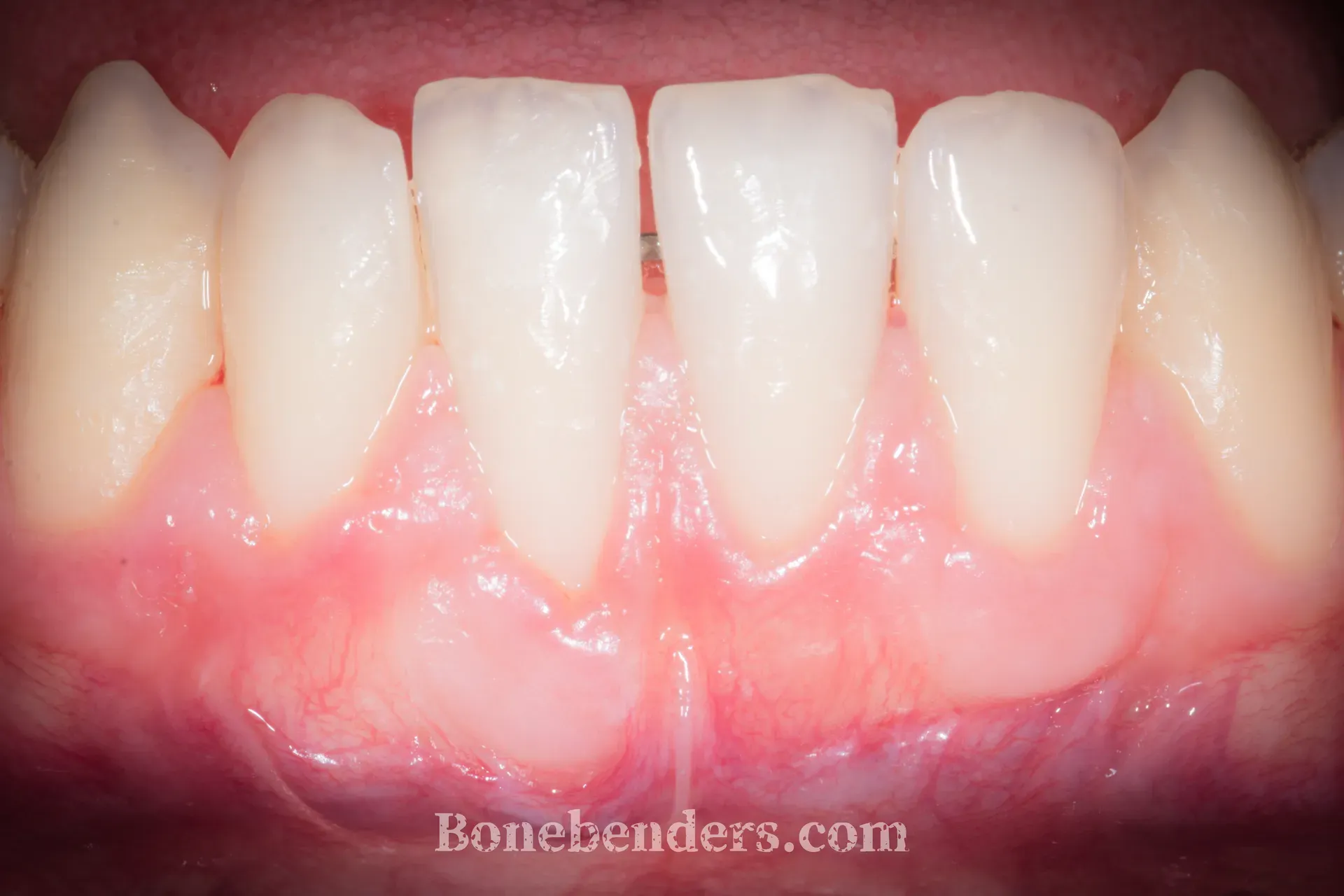 Copertura radicolare completa su incisivo inferiore dopo innesto connettivale — risultato a 2 mesi