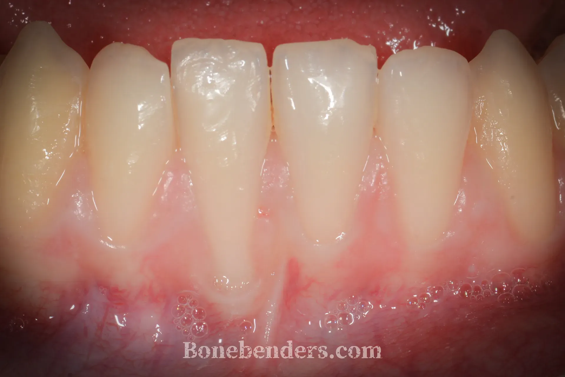 Recessione gengivale grave su incisivo mandibolare con esposizione radicolare — situazione clinica pre-operatoria