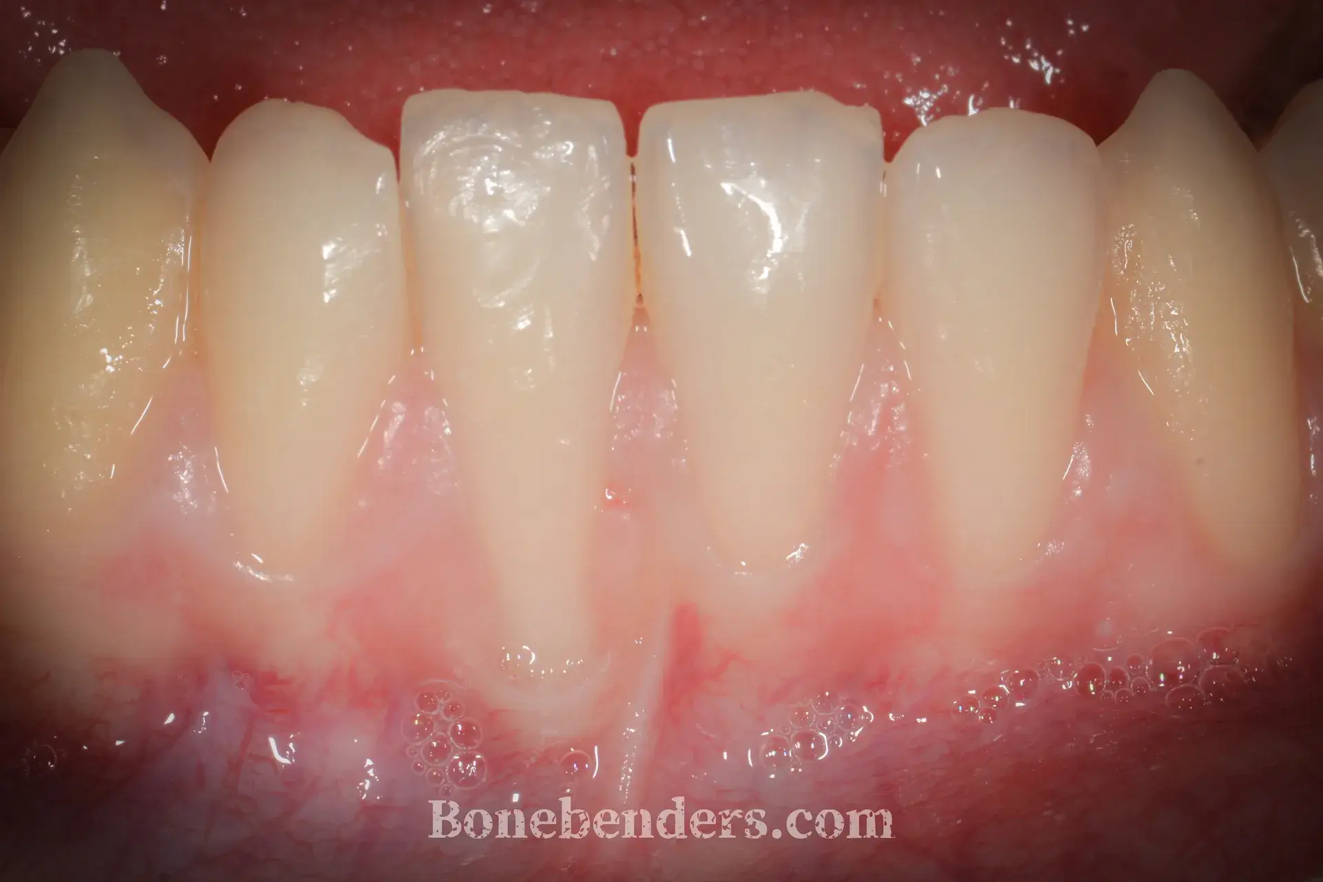 Recessione gengivale grave su incisivo mandibolare con esposizione radicolare — situazione clinica pre-operatoria