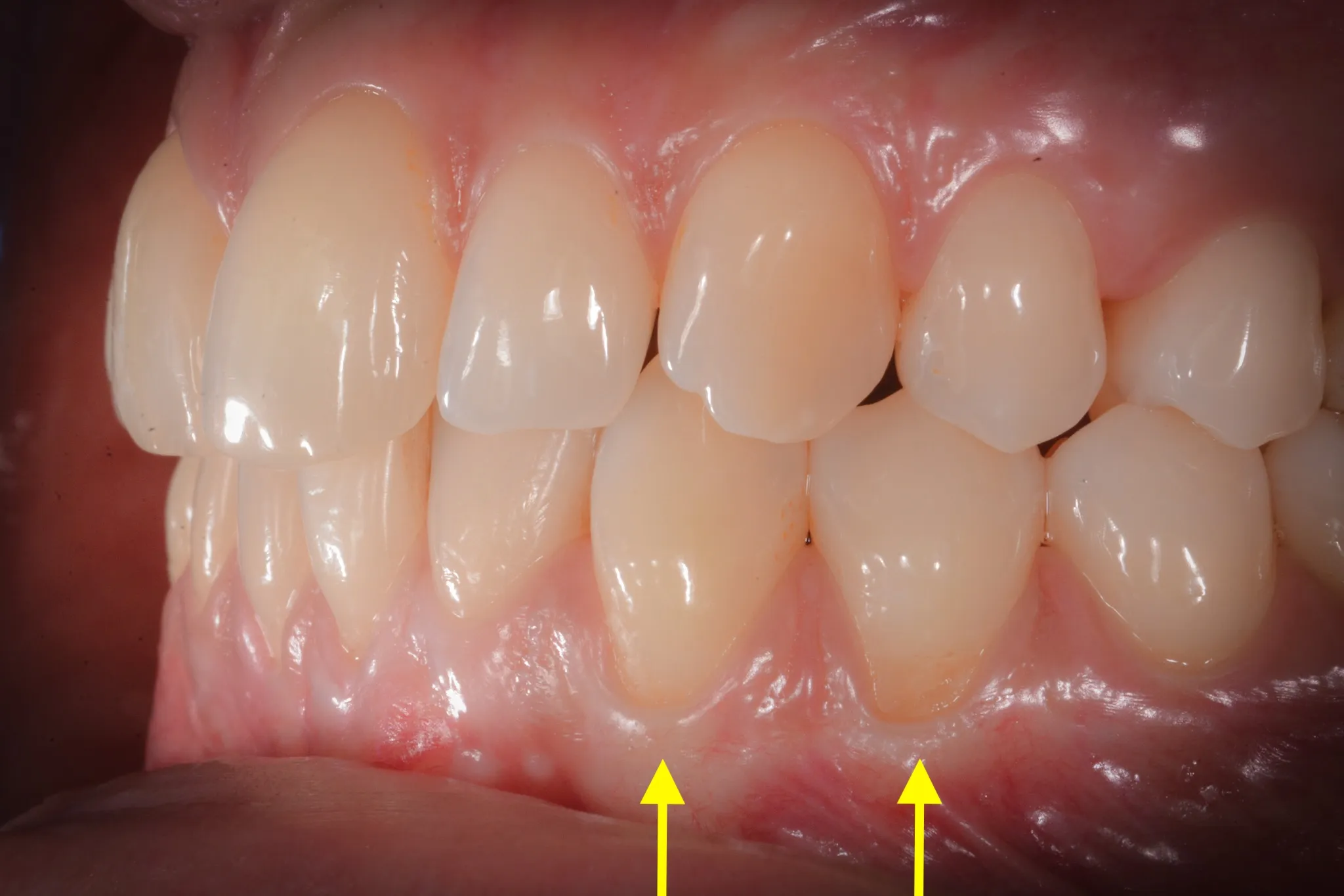 Recessioni gengivali prima del trattamento — visione panoramica con frecce che indicano le recessioni