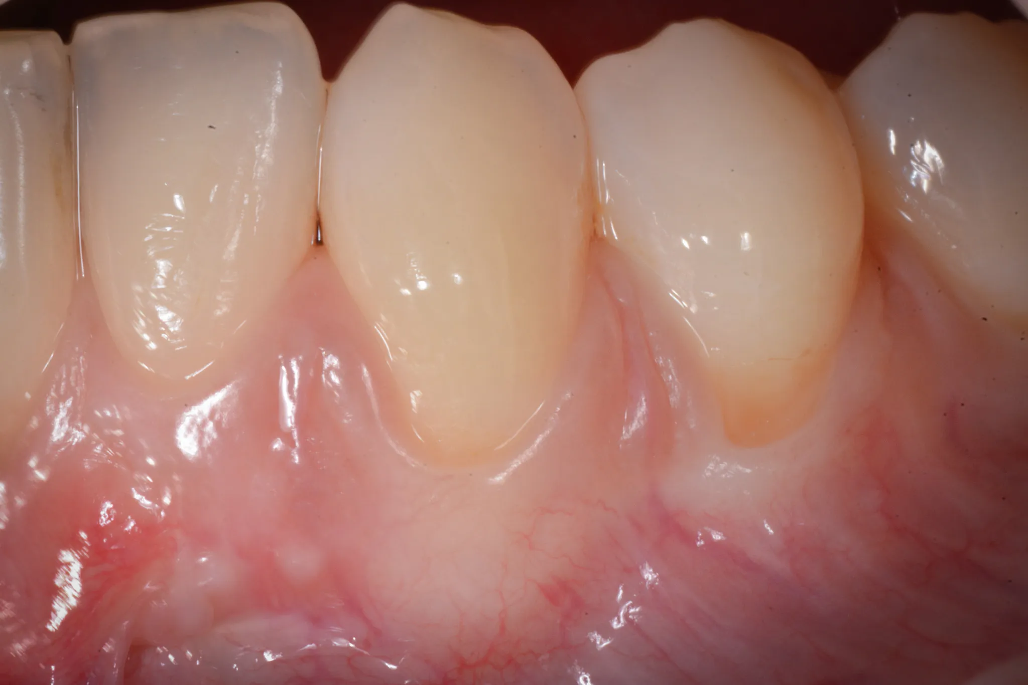 Dettaglio delle recessioni gengivali prima del trattamento chirurgico