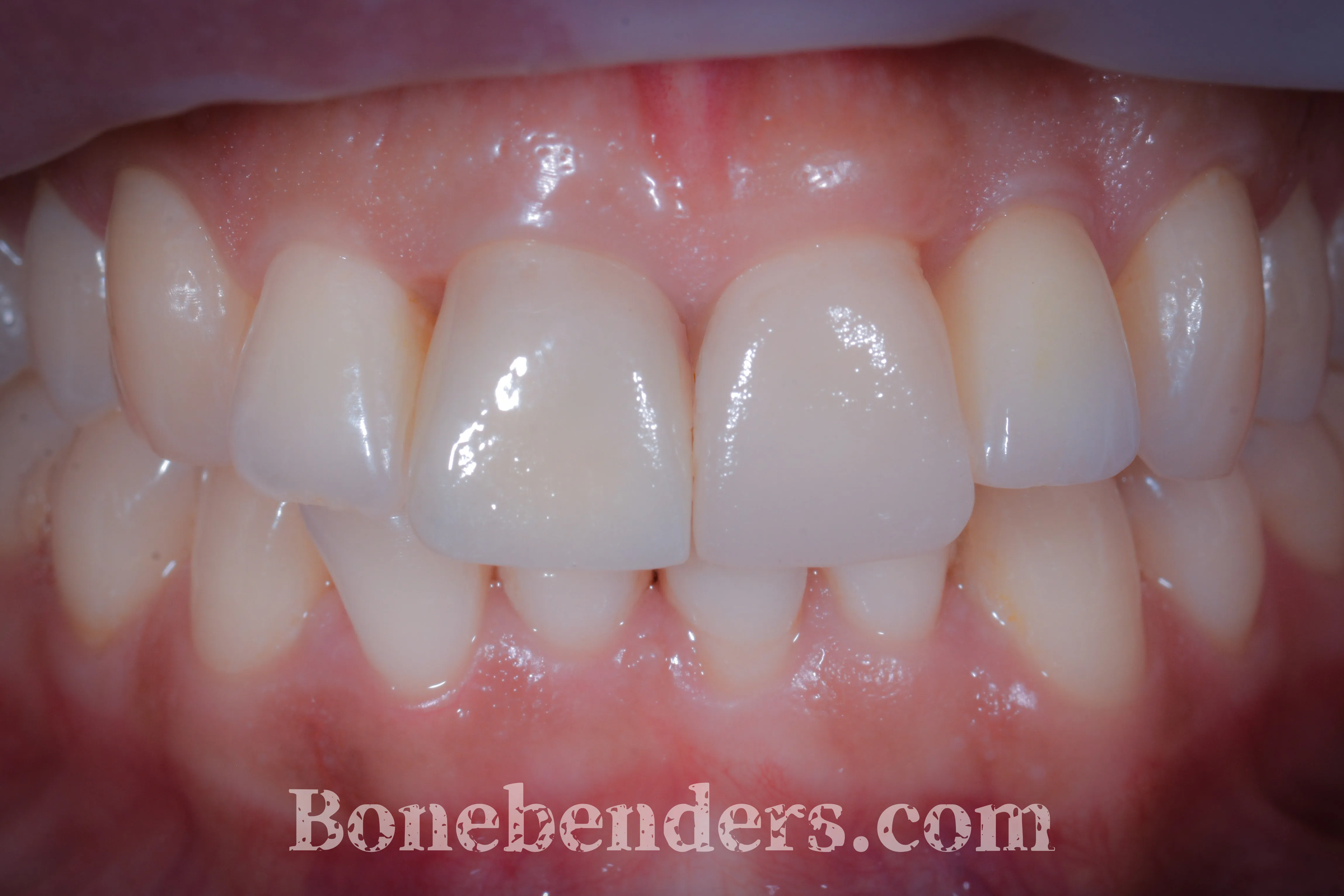 Riabilitazione estetica completata con corone e faccette in ceramica su impianti — risultato a 6 mesi