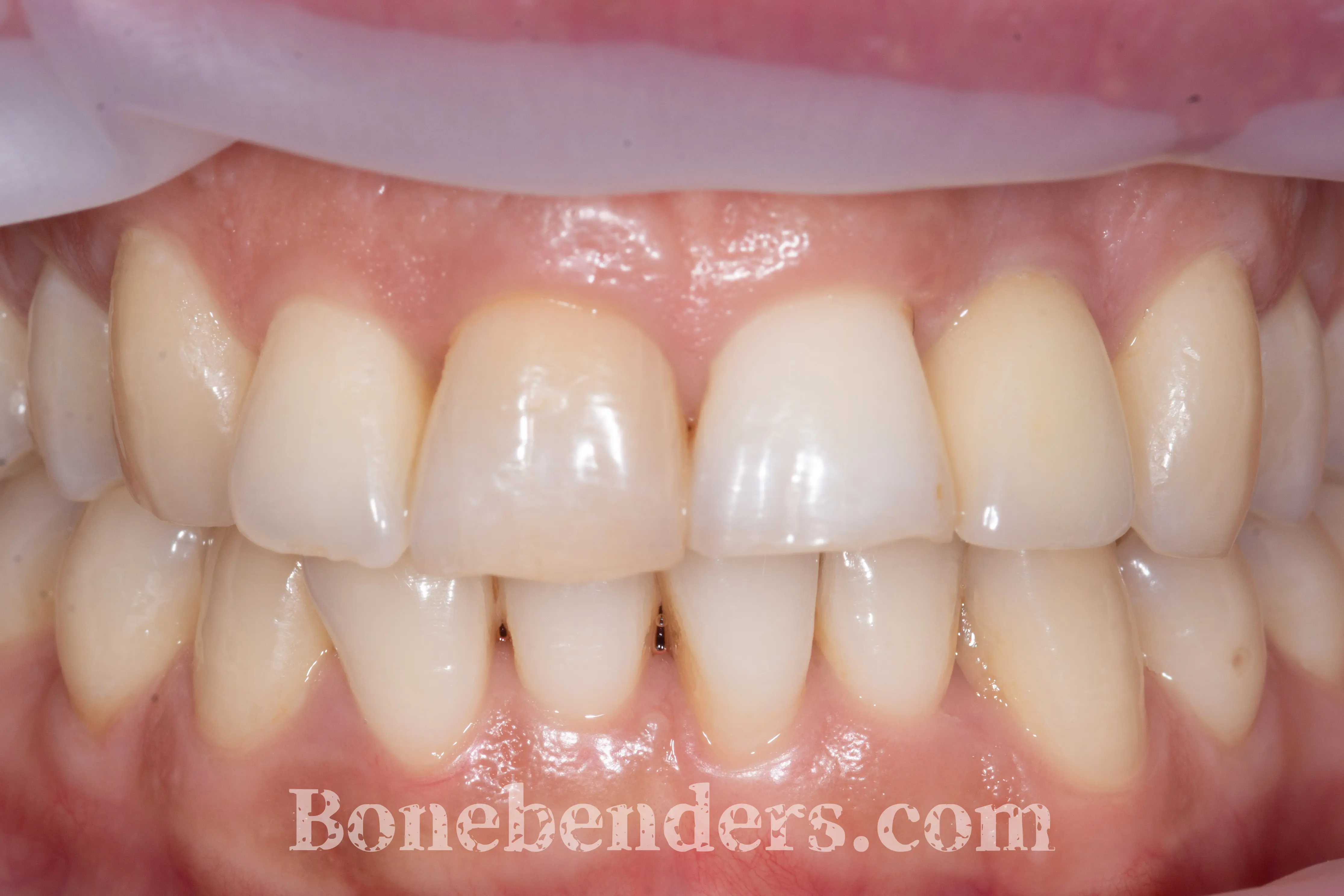 Sorriso con discromie, restauri incongrui e disarmonia estetica del settore anteriore — situazione clinica pre-operatoria