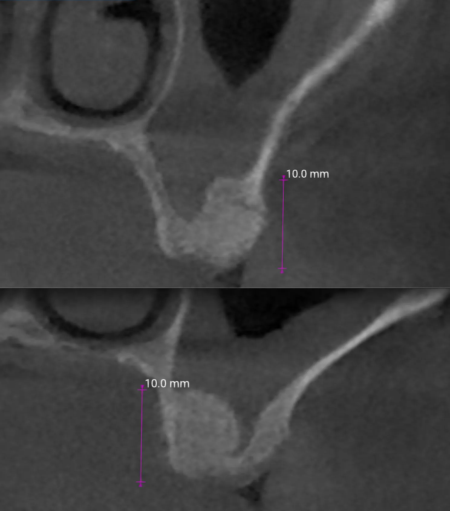 Controllo con CBCT a 2 mesi con evidente ed esteso sollevamento in particolare a livello degli ex alveoli radicolari