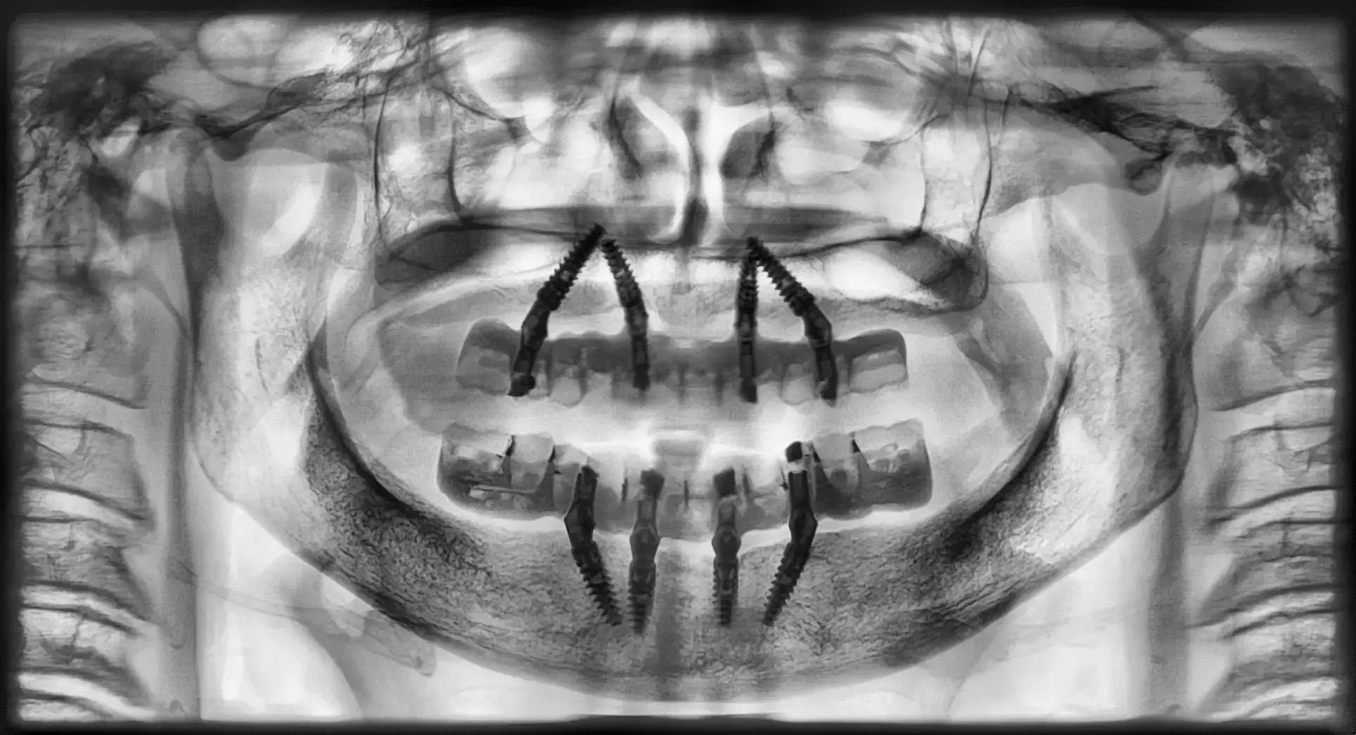 Inverted-contrast panoramic radiograph at six months: four implants per arch, the distal ones tilted, under two screw-retained fixed prostheses