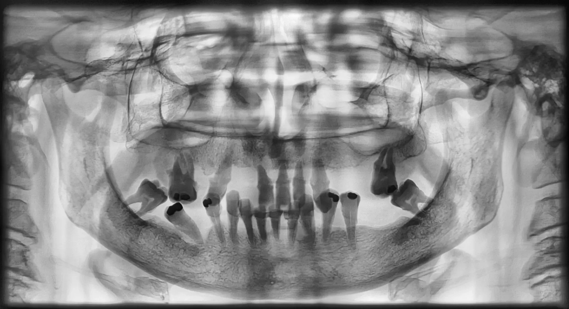 Panoramica pre-operatoria a contrasto invertito: dentatura residua compromessa in entrambe le arcate e mascellare superiore atrofico sotto seni mascellari pneumatizzati