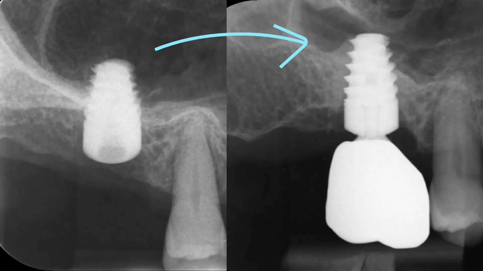 Confronto radiografico prima/dopo: a sinistra la cresta atrofica con seno mascellare basso, a destra l'impianto integrato e protesizzato dopo rialzo crestale graftless con espansione della corticale, senza innesto