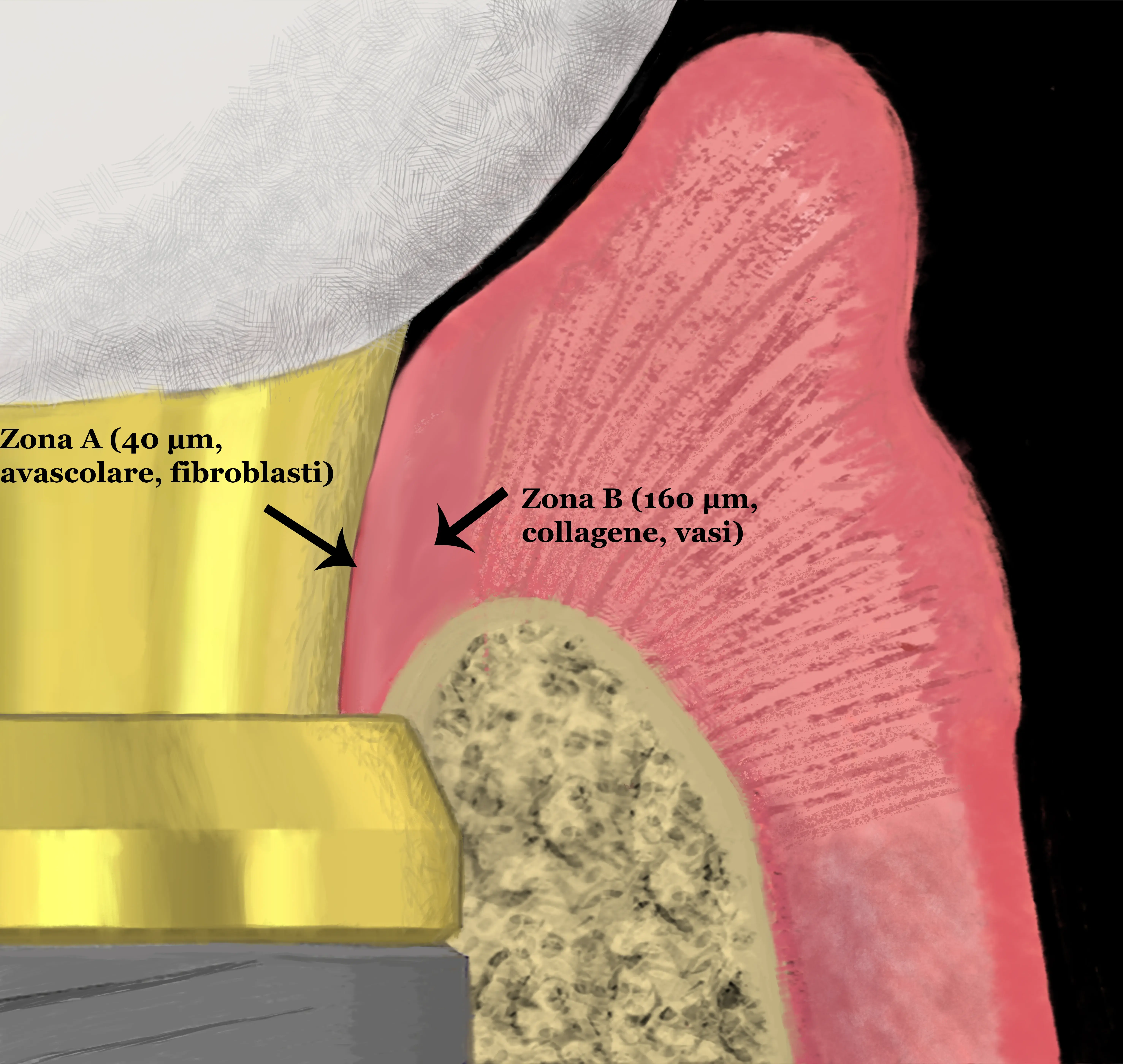 Sezione anatomica del sigillo peri-implantare: Zona A avascolare (fibroblasti) e Zona B vascolarizzata (collagene) intorno all'abutment implantare