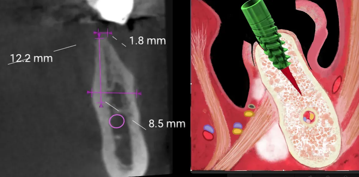 Split Crest ERE: 98.1% Successo ma “non funziona”