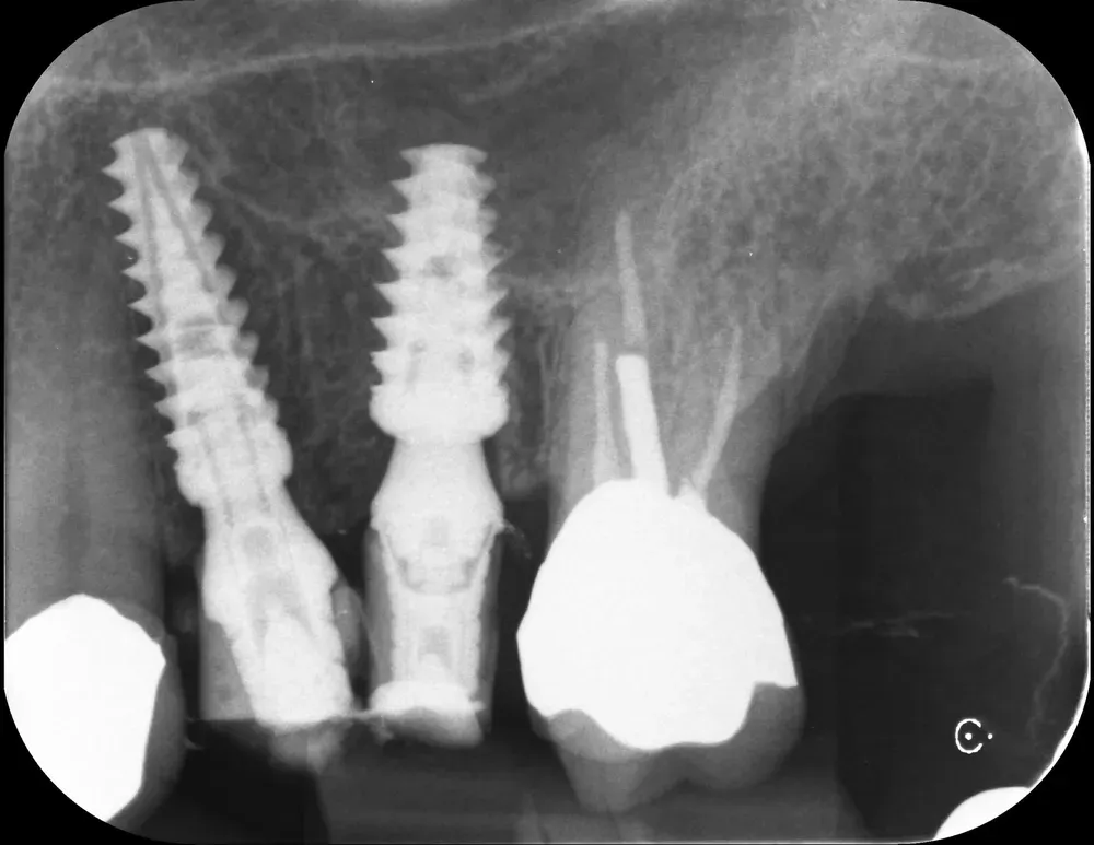 Rx Periapicale con abutment e provvisori