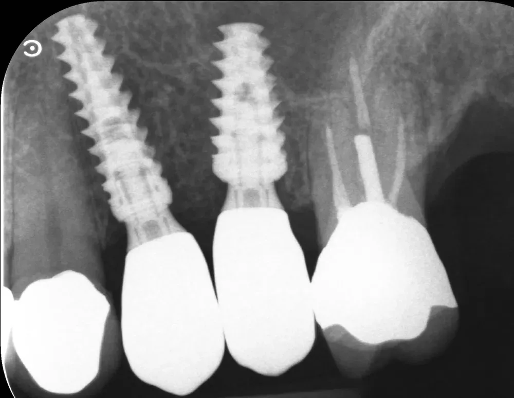 
Rx periapicale alla consegna delle corone in zirconia