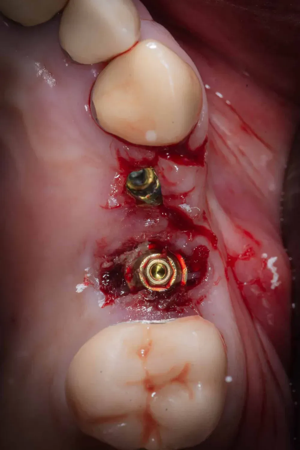 Immagine occlusale immediatamente dopo l