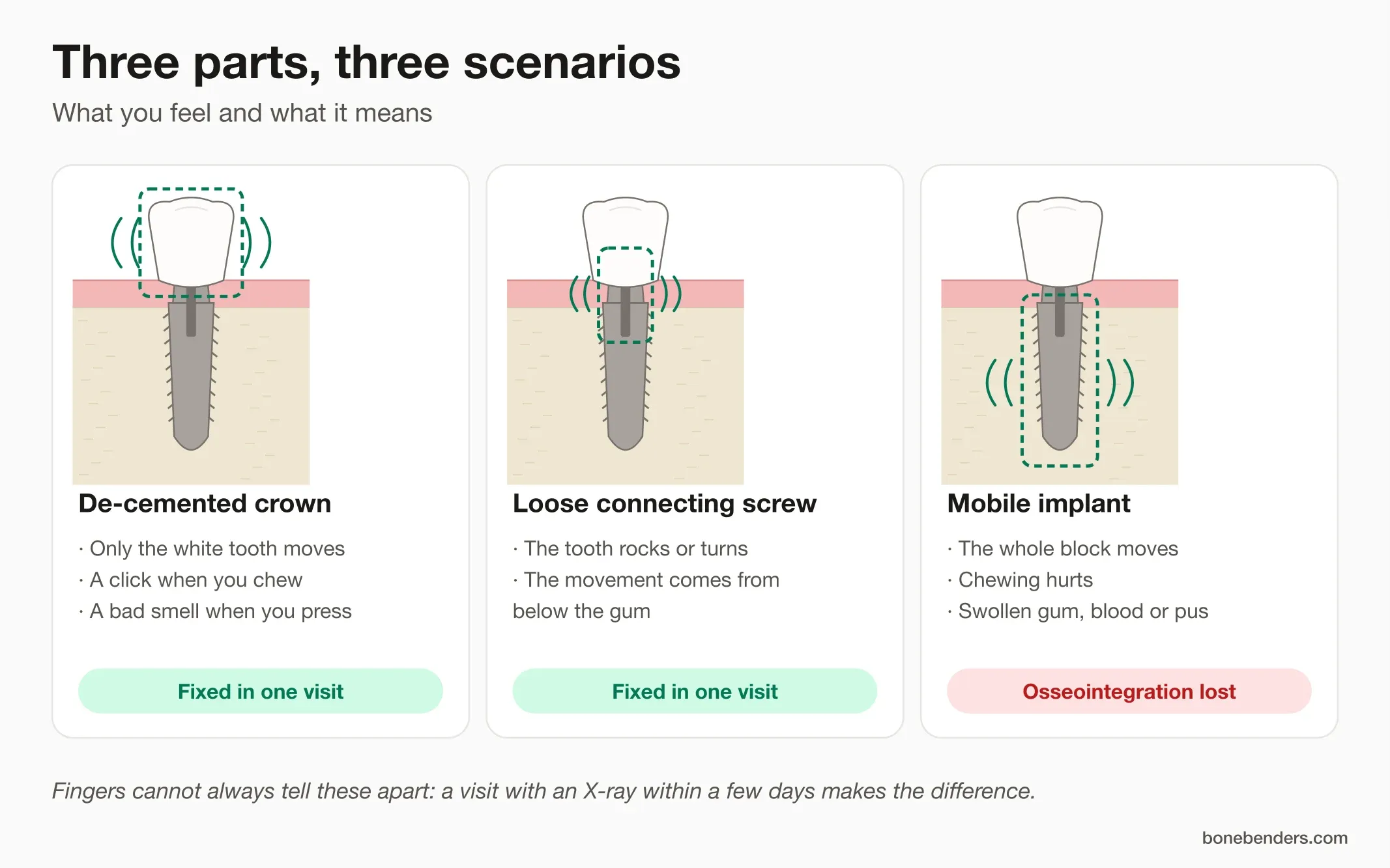 Infographic: three scenarios compared, de-cemented crown, loose connecting screw and mobile implant, with typical signs and outcome