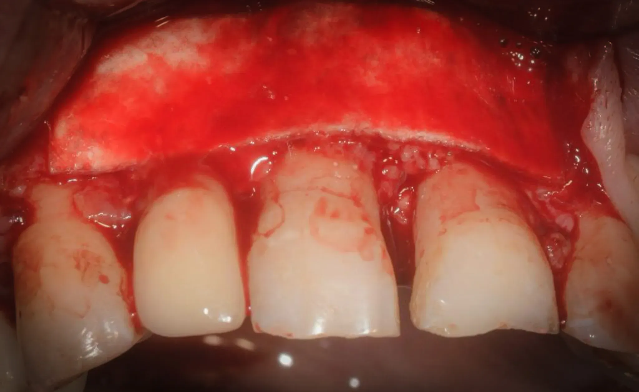 Porcine cortical lamina positioned as a semi-rigid barrier covering the graft and defect