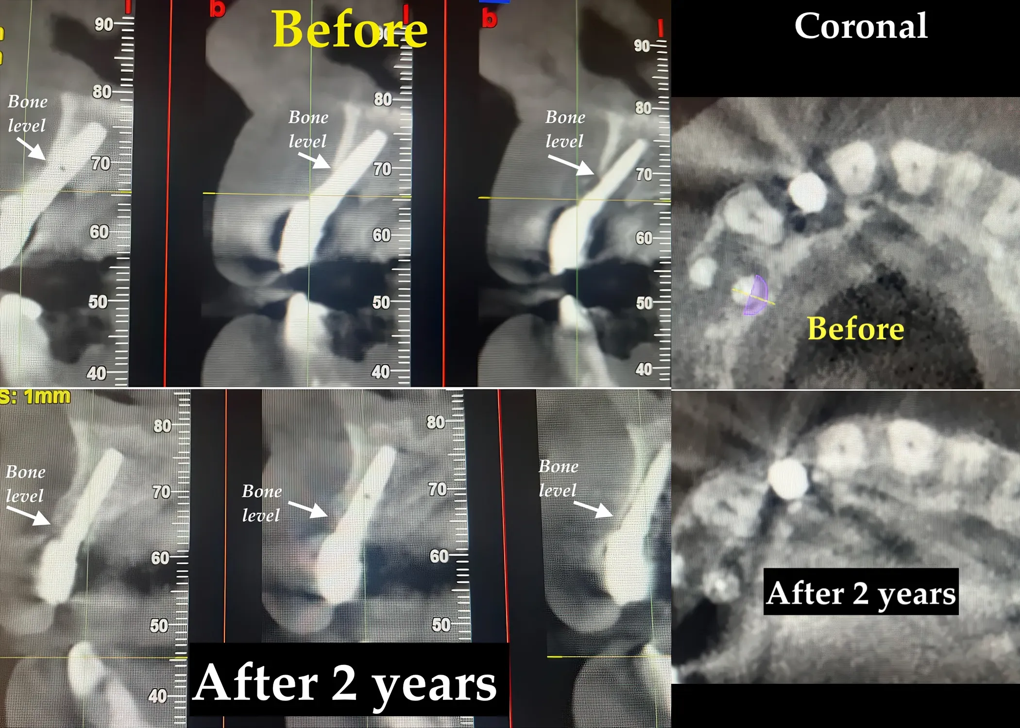 Radiographic comparison before and after peri-implantitis treatment with TST technique: CBCT and periapical X-rays at 2 years