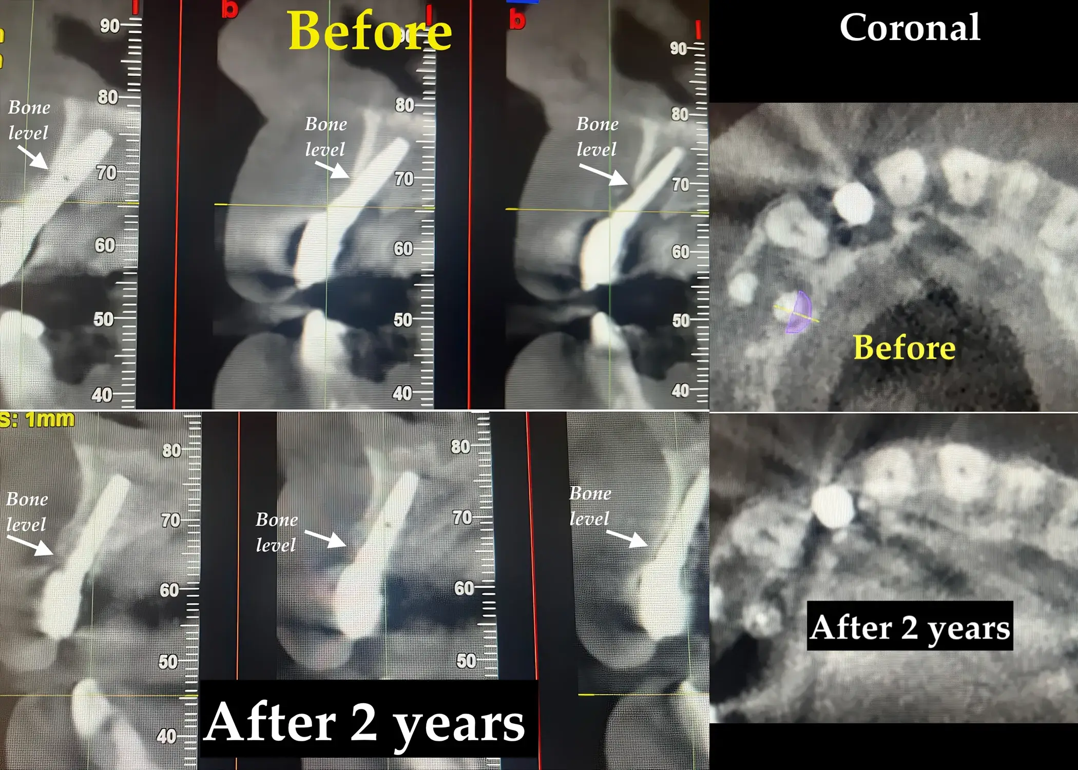 Radiographic comparison before and after peri-implantitis treatment with TST technique: CBCT and periapical X-rays at 2 years