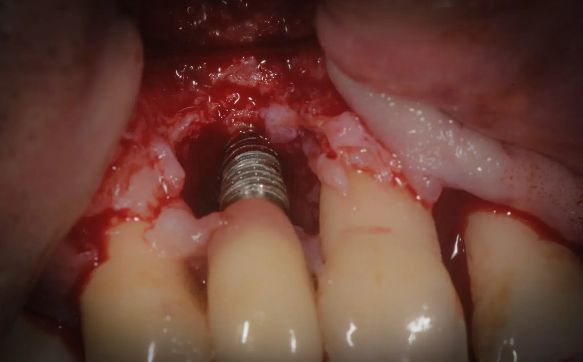 Surgical field after TST decontamination: white precipitate visible on the implant surface. Crater-shaped defect exposed
