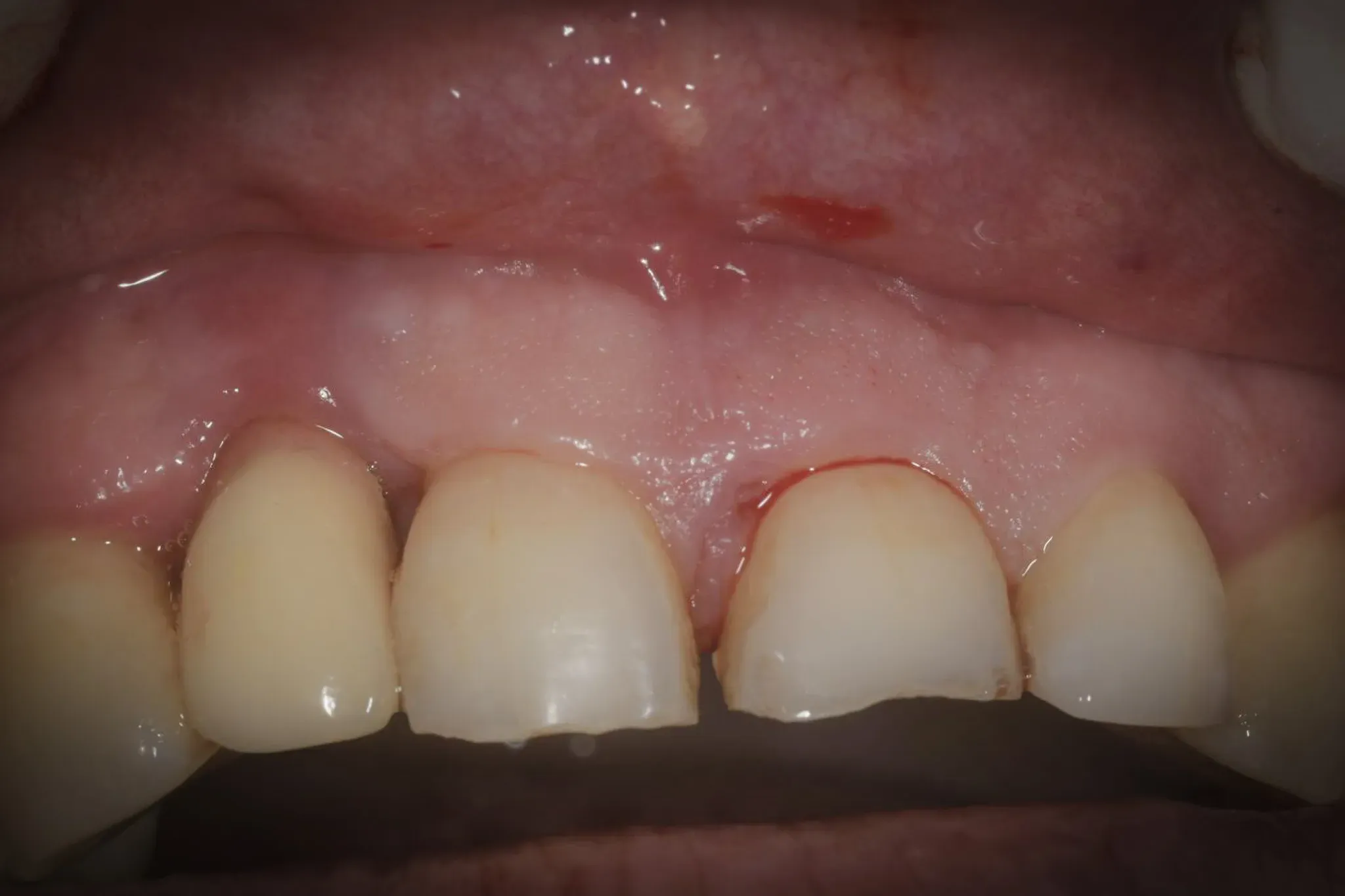 Preoperative view: implant at 1.2 with peri-implantitis and periodontal involvement of adjacent teeth