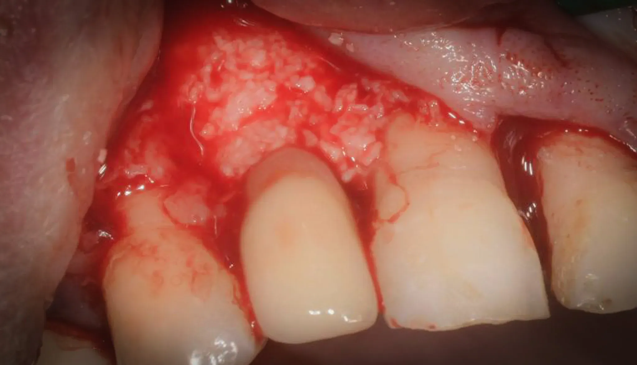 Collagenated xenograft with fibrin glue placed in the peri-implant defect