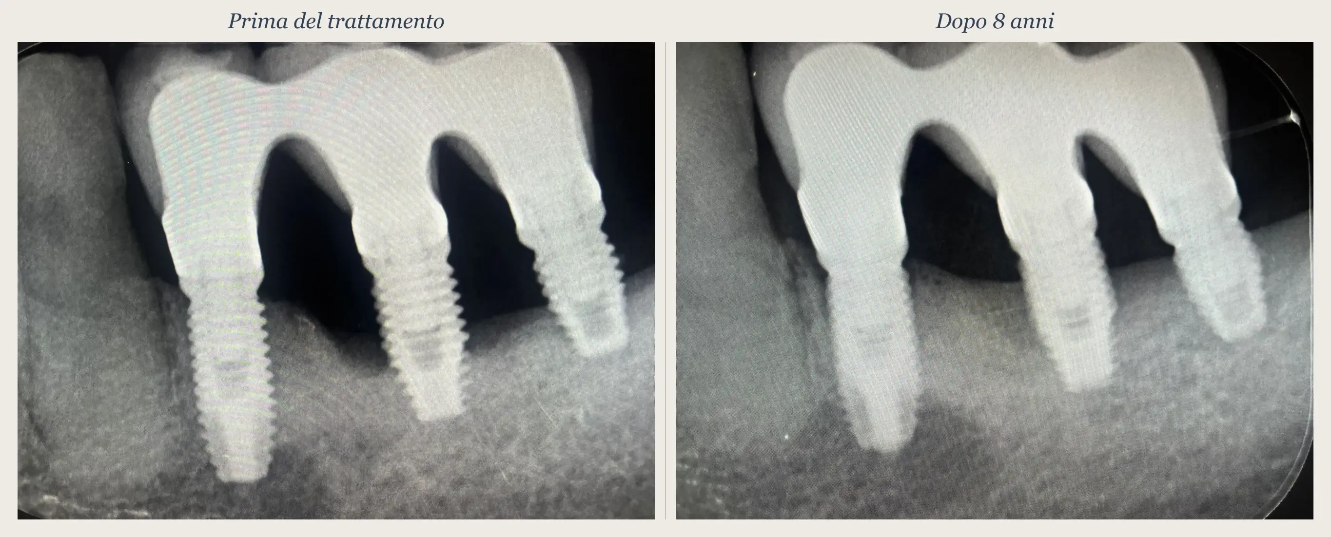 Confronto radiografico prima e dopo: peri-implantite trattata in modo non chirurgico con tecnica TST, follow-up a 8 anni con fill osseo periimplantare