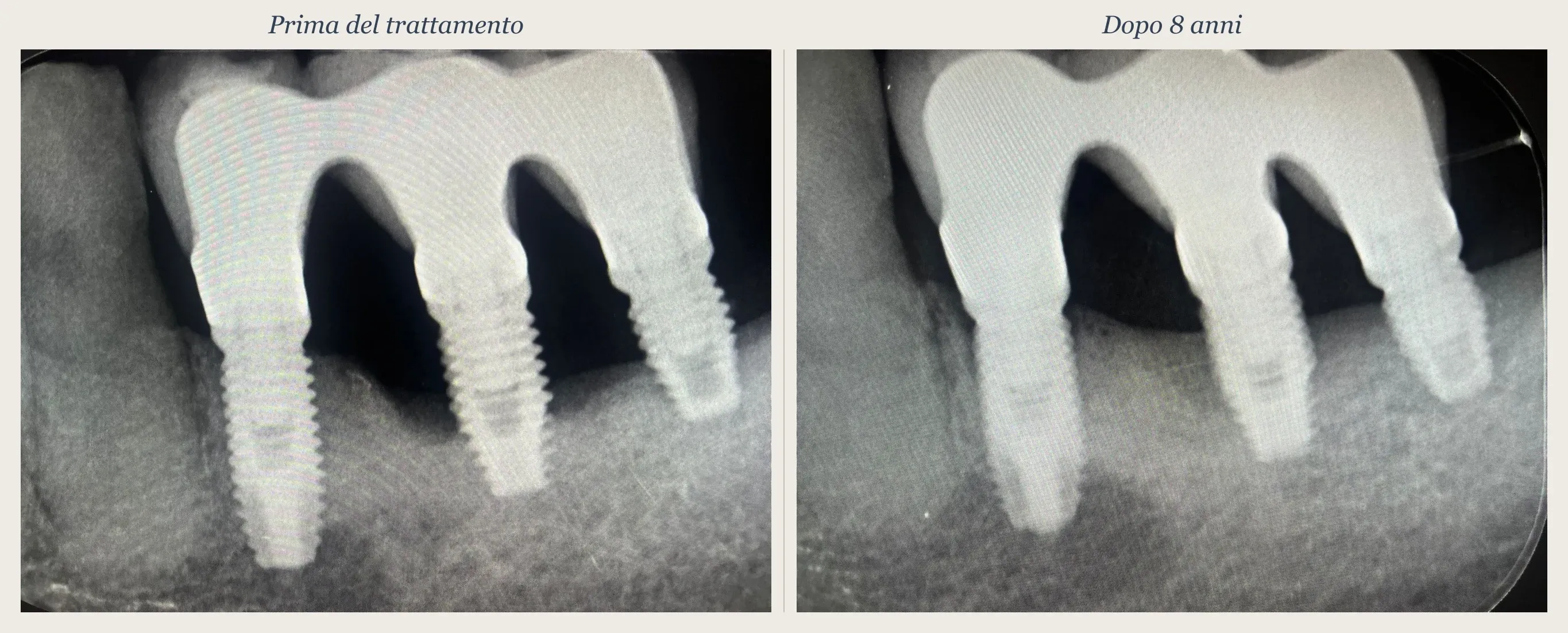 Radiographic before-and-after comparison: peri-implantitis treated non-surgically with the TST technique, 8-year follow-up with peri-implant bone fill