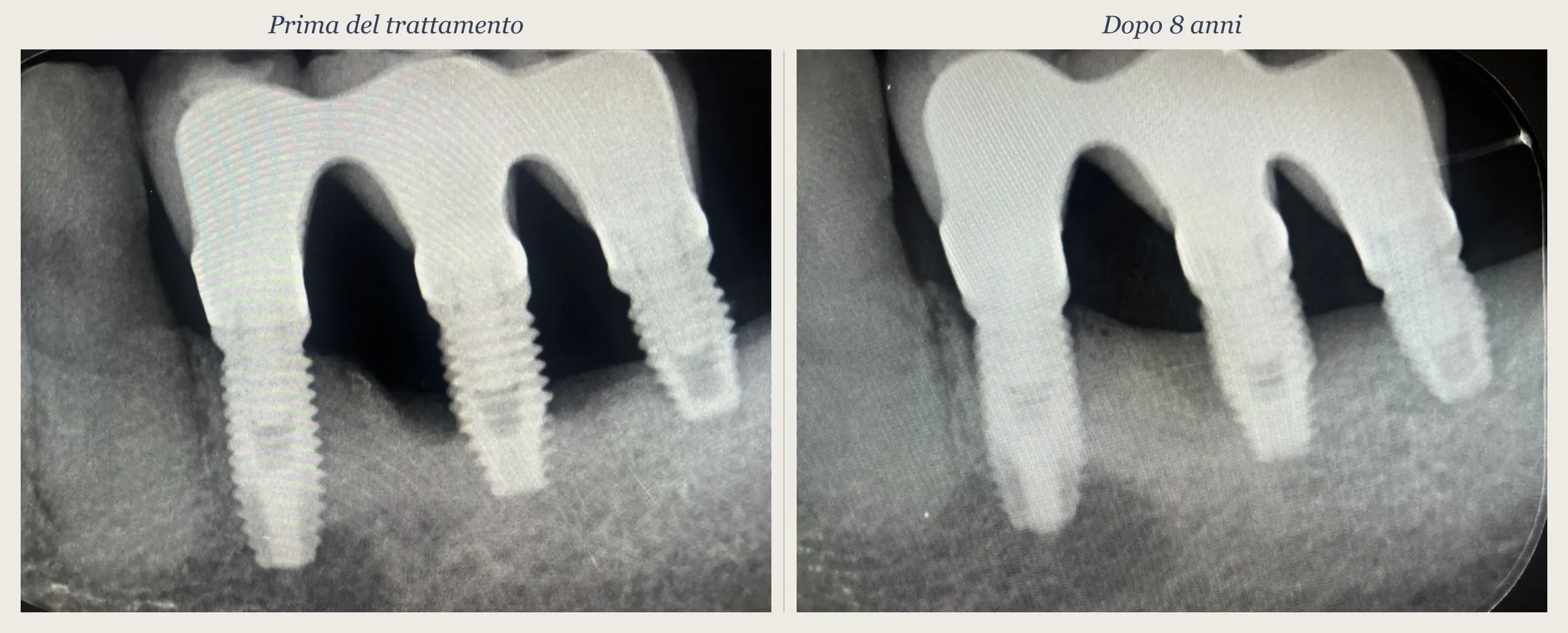 Radiographic before-and-after comparison: peri-implantitis treated non-surgically with the TST technique, 8-year follow-up with peri-implant bone fill