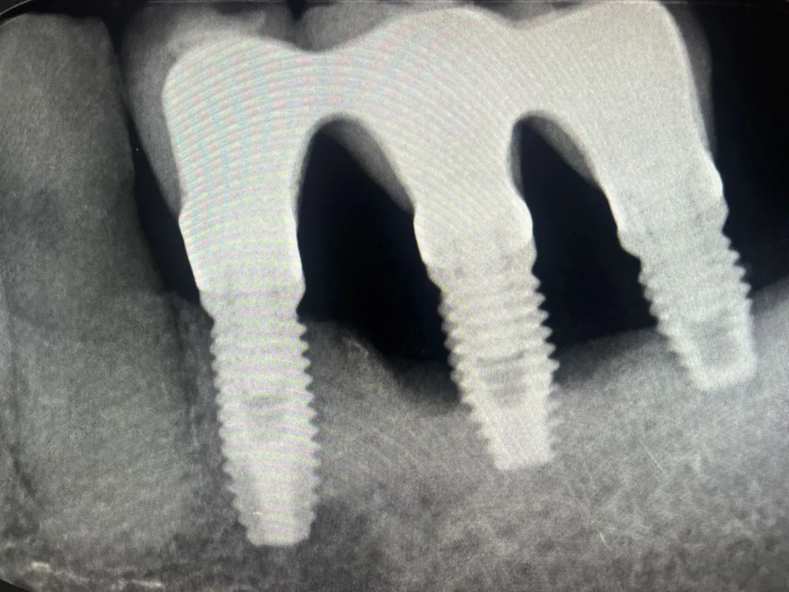 Initial situation: vertical peri-implant bone defects on the three splinted implants, exposed threads