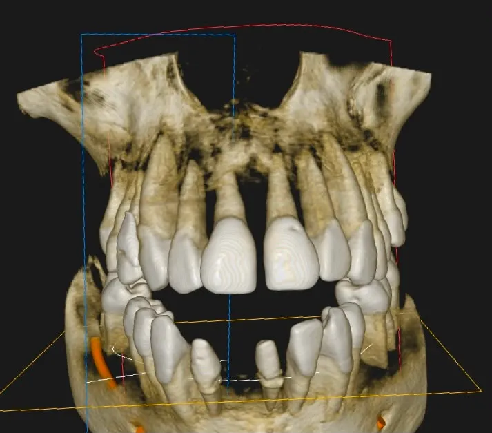 CBCT 3D reconstruction: vestibular migration and severe loss of bone support