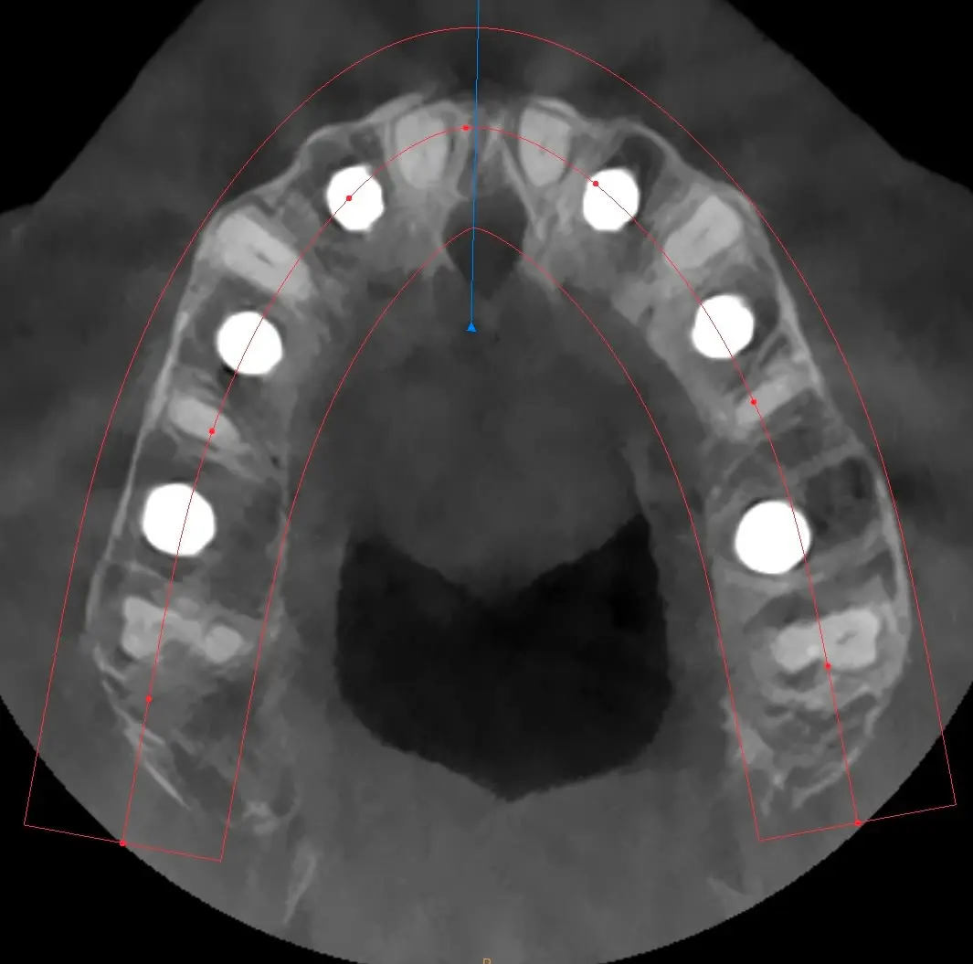 Axial CBCT: six maxillary implants placed using the Bonebenders technique