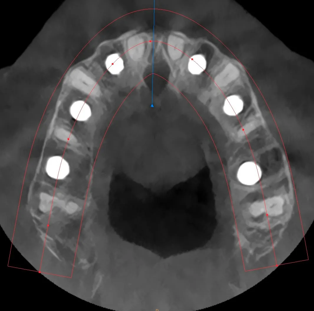 Axial CBCT: six maxillary implants placed using the Bonebenders technique