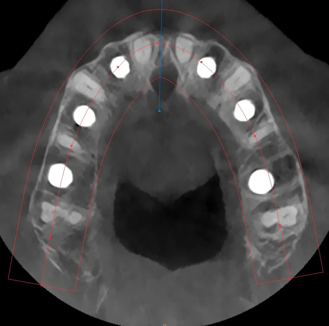 CBCT assiale: sei impianti mascellari posizionati con tecnica Bonebenders
