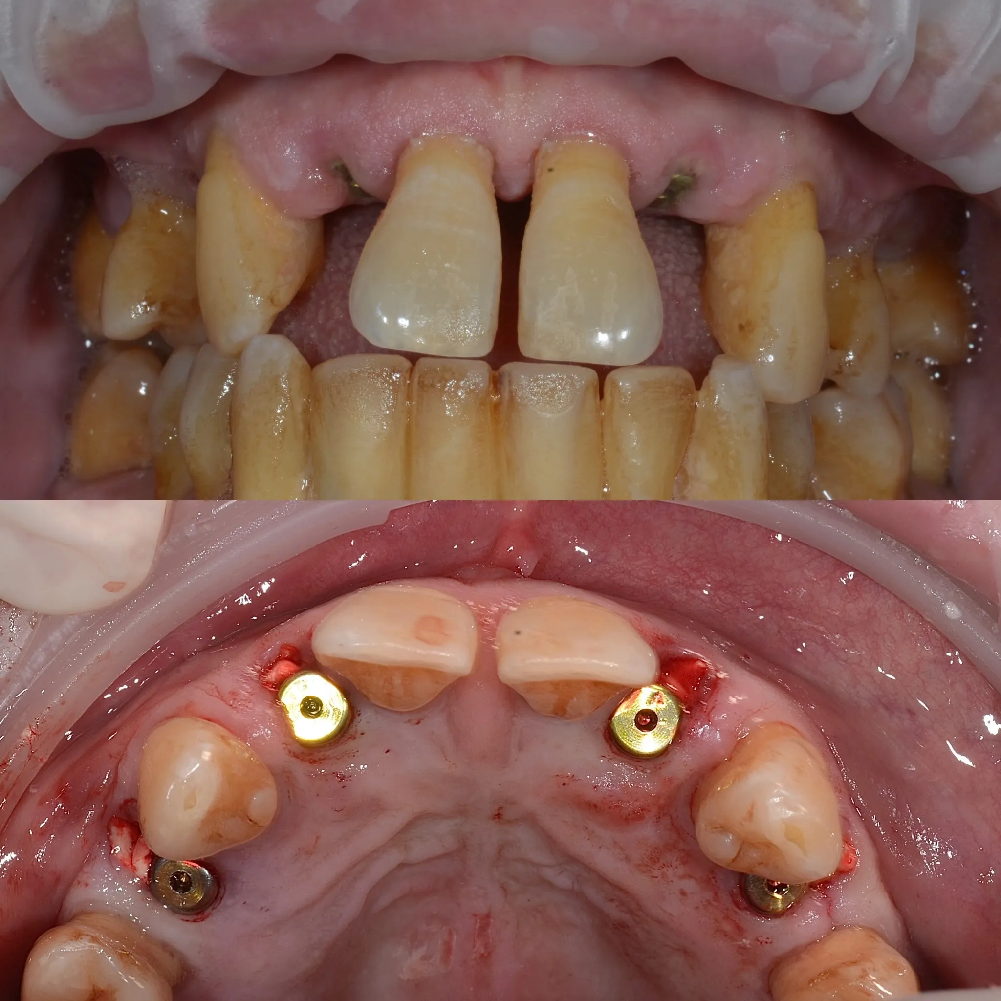 Top: initial clinical situation with recessions and vestibular migration. Bottom: occlusal view after extractions with implant healing screws