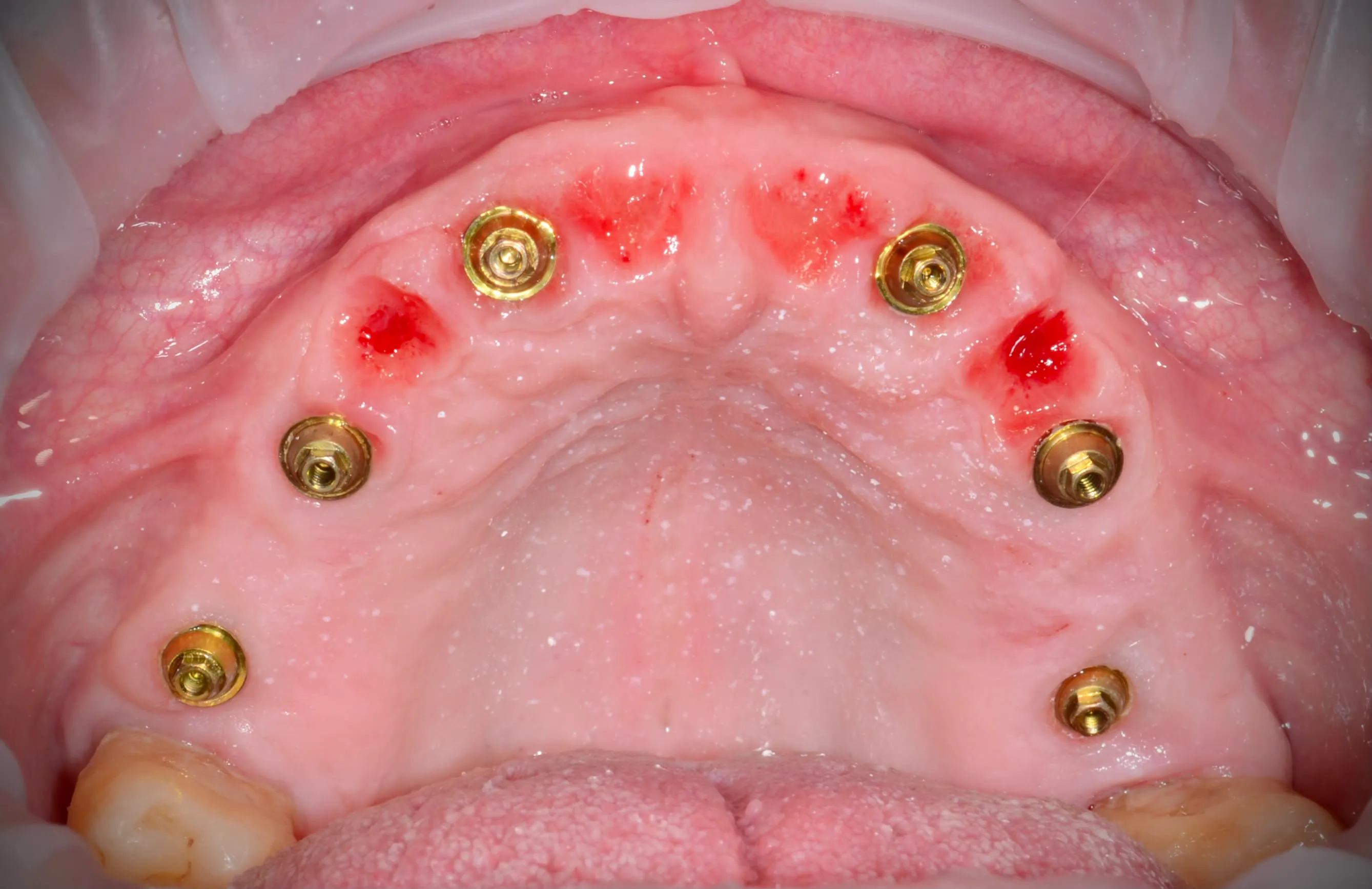Occlusal view: six implants with healing screws, healed soft tissues, elements 17 and 27 retained
