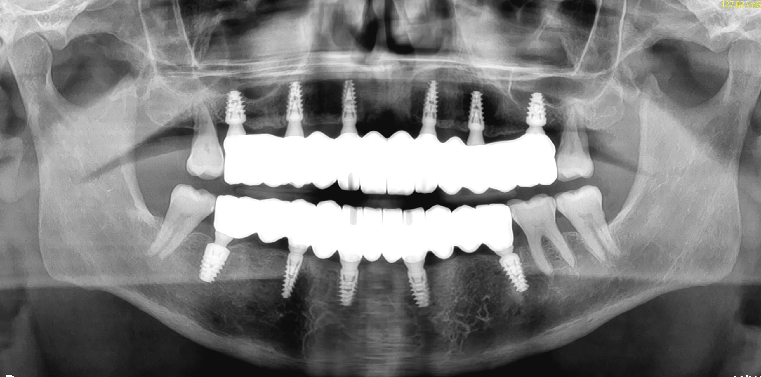 Final panoramic radiograph: complete bimaxillary implant-prosthetic rehabilitation