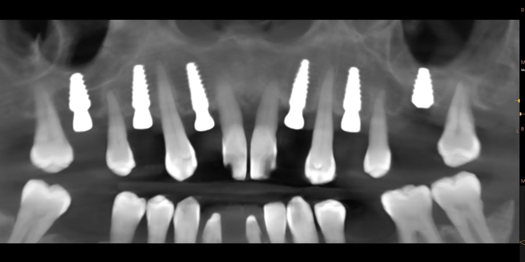Post-operative panoramic radiograph: six maxillary implants with residual teeth 17 and 27 still in situ as provisional abutments