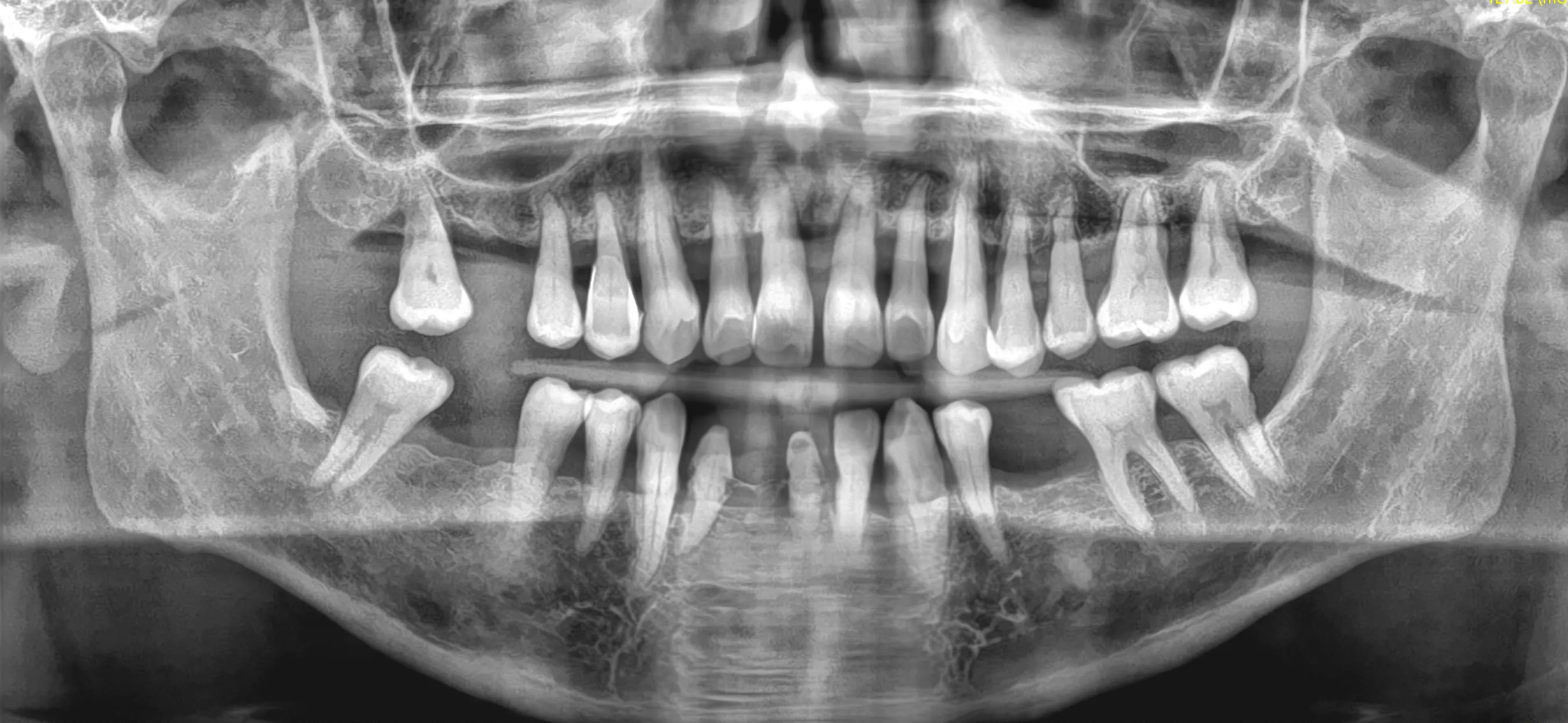 Pre-operative panoramic radiograph: advanced periodontitis with generalised bone loss