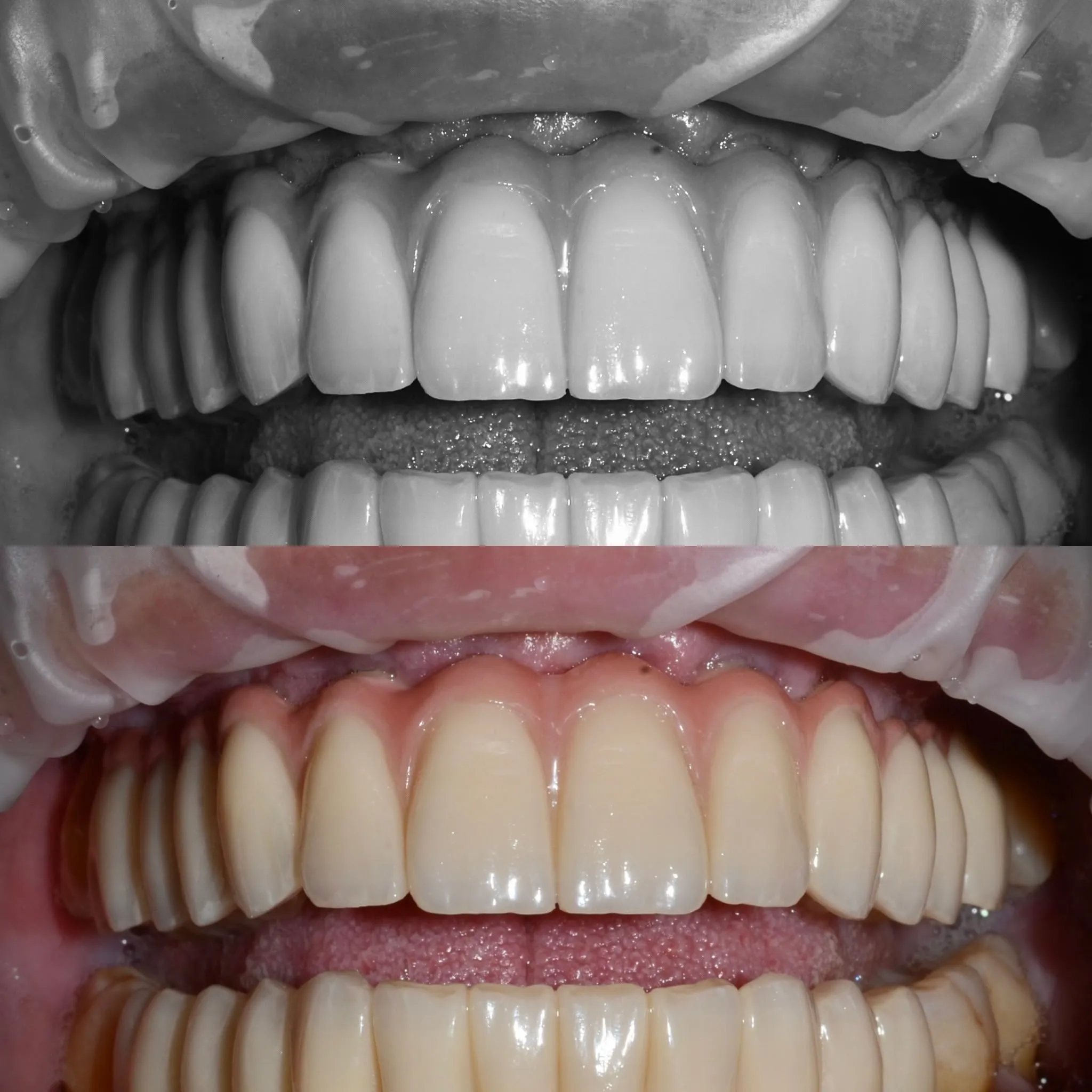 Top: aesthetic trial of the provisional. Bottom: provisional prosthesis in situ