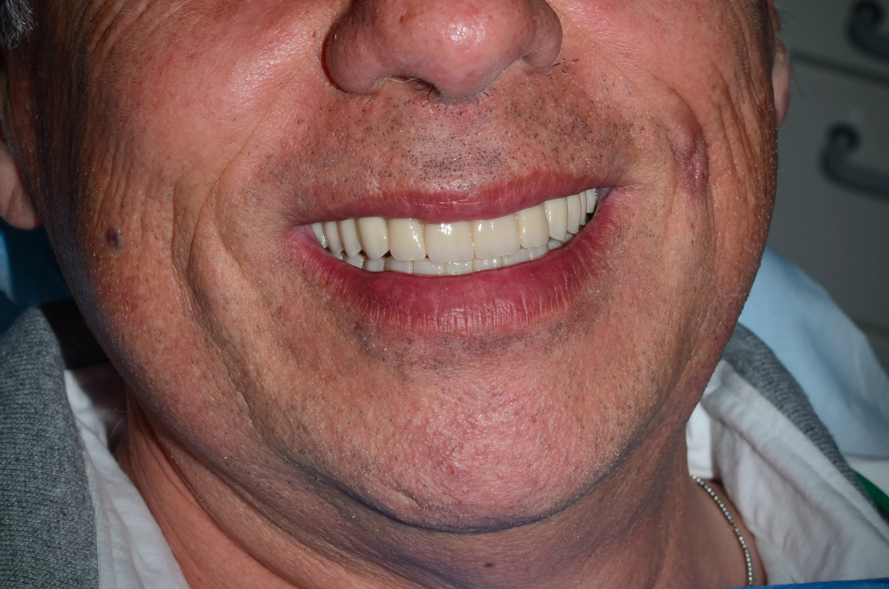 Final result: the patient's smile after complete maxillary rehabilitation