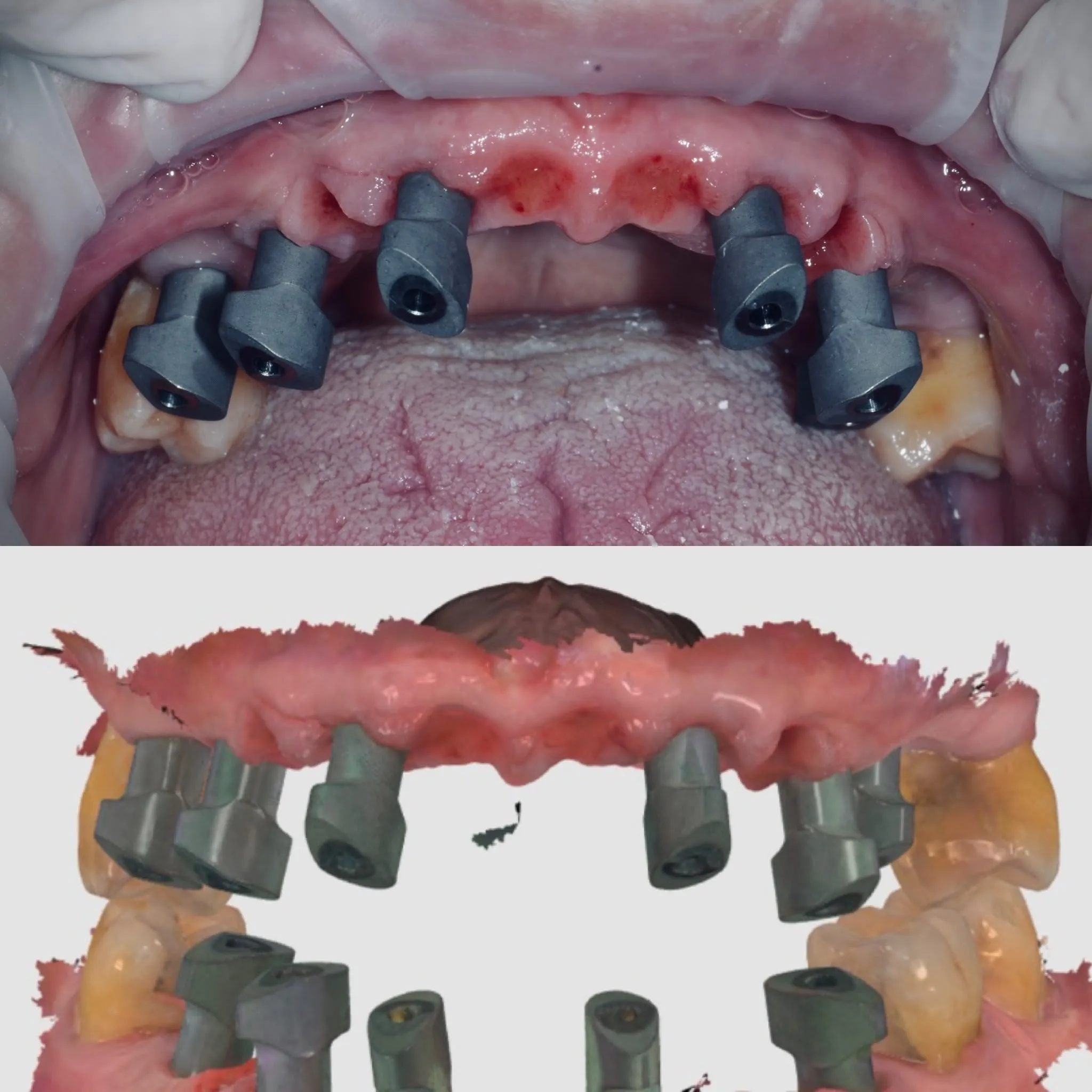 Top: scan bodies positioned for digital impression. Bottom: intraoral 3D scan