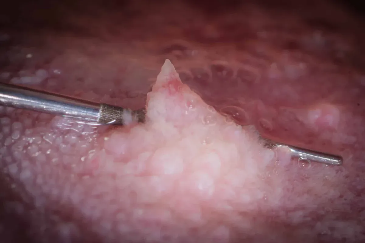 Una Piccola Grande Storia Dimostra L’efficacia dei Vaccini