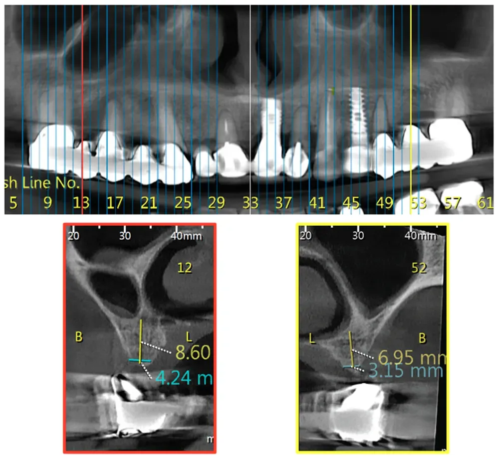 Classe 3 bilaterale della variante Big nose del seno mascellare