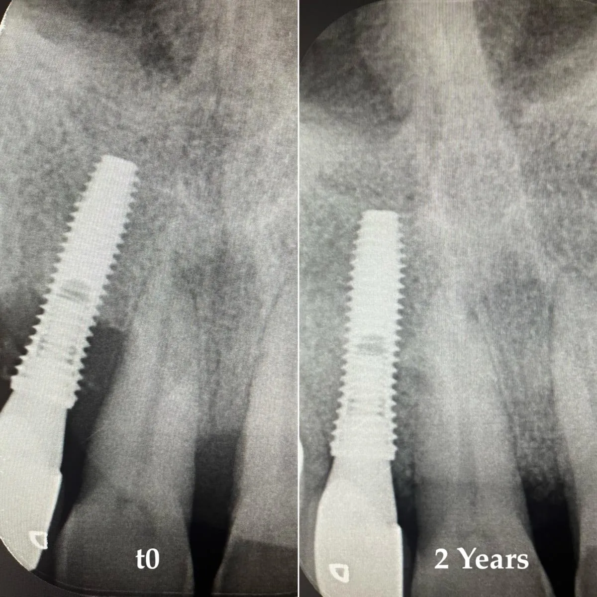 Periapical radiographs: comparison before treatment and at 2-year follow-up. Bone fill visible in the peri-implant defect