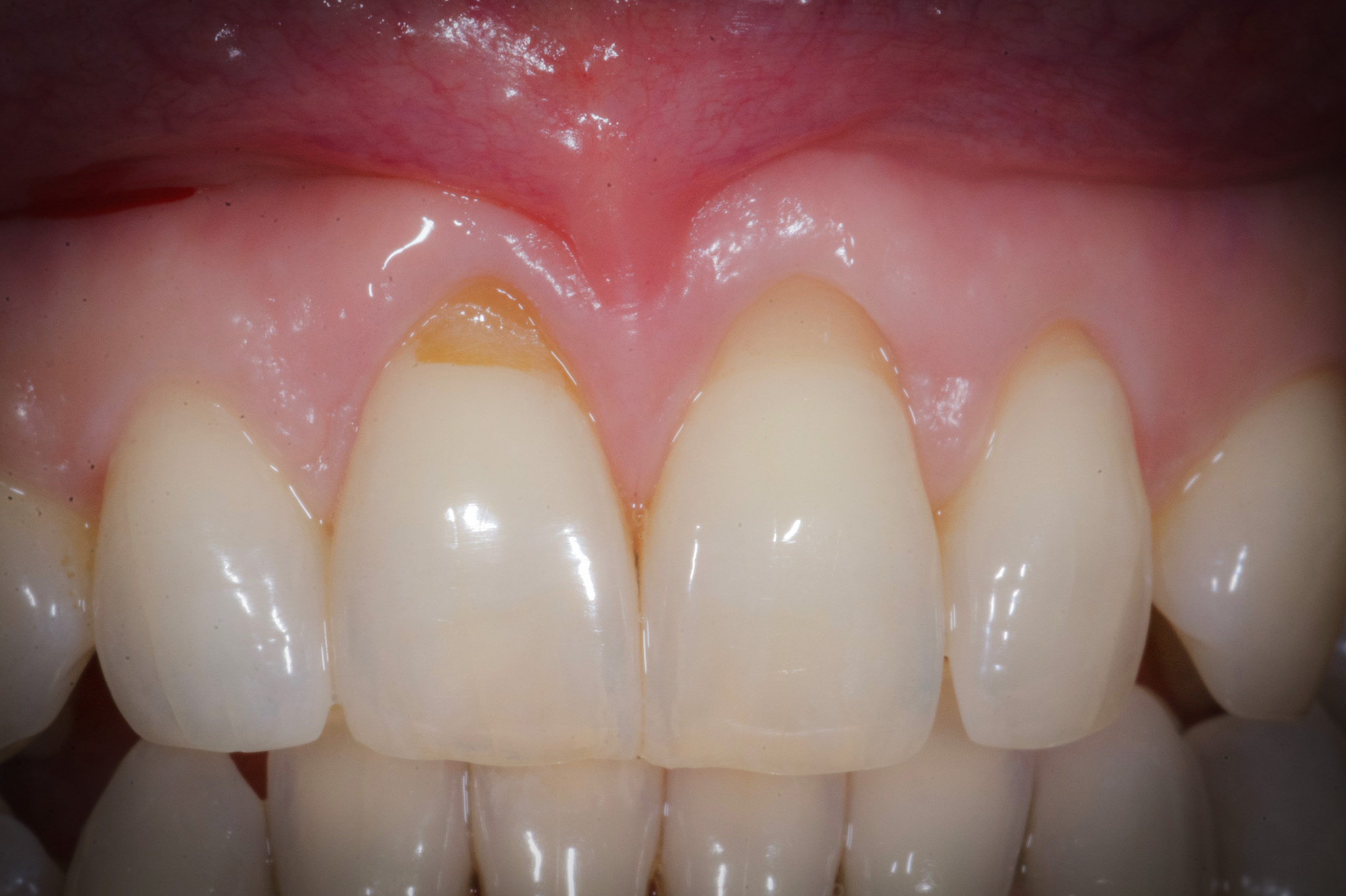 Quando occorre un innesto gengivale e quando no?