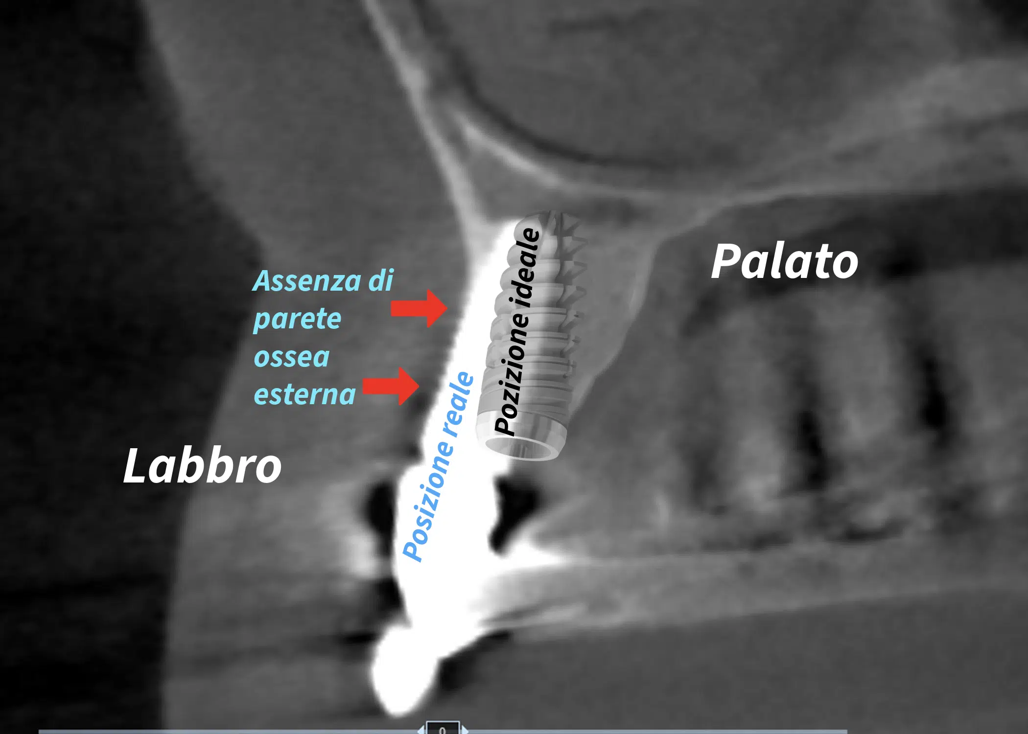 Impianto Dentale Mal Posizionato: Conseguenze Biomeccaniche