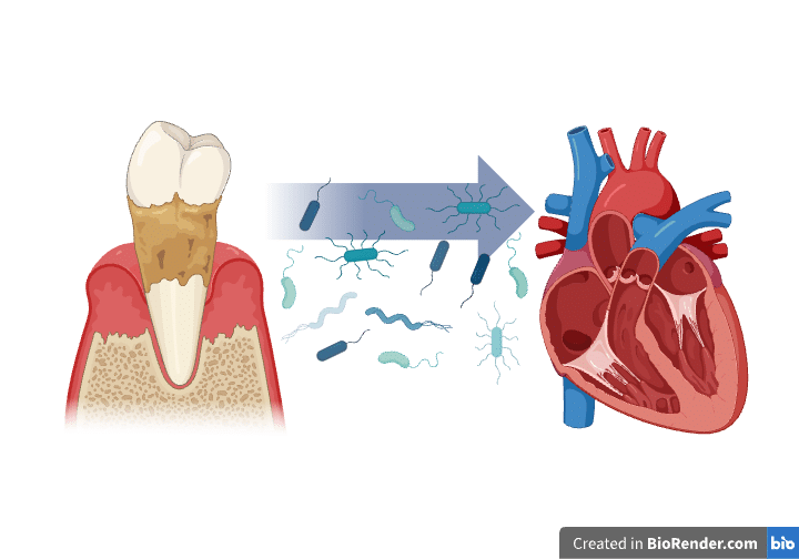 Pathway from Dental Infection to Cardiovascular Complications - Bonebenders Pathway from Dental Infection to Cardiovascular Complications Pathway from Dental Infection to Cardiovascular Complications