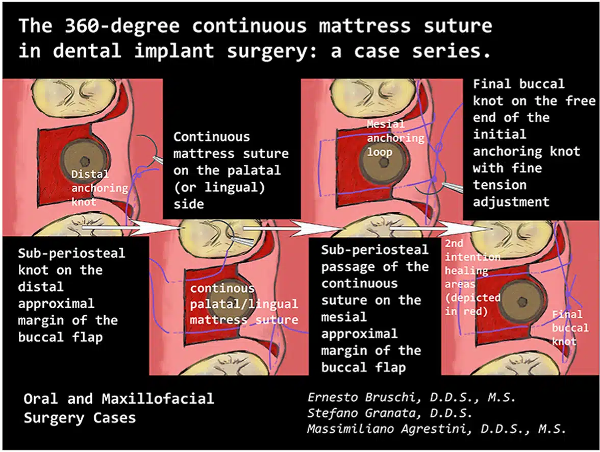 1-s20-S2214541923000202-ga1_lrg - Bonebenders 1-s20-S2214541923000202-ga1_lrg The 360-degree continuous mattress suture in dental implant surgery: A case series