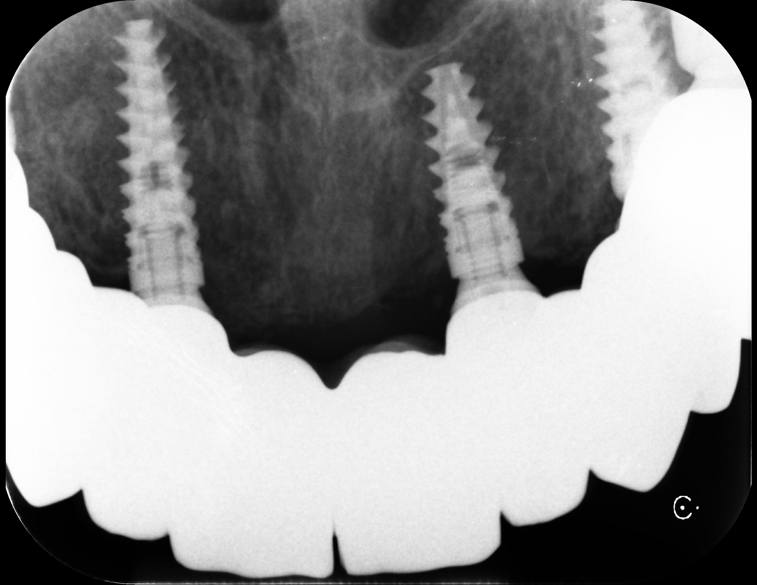 13197_PROIETTI_NADIA_20250709-164300 Dental implant reconstruction