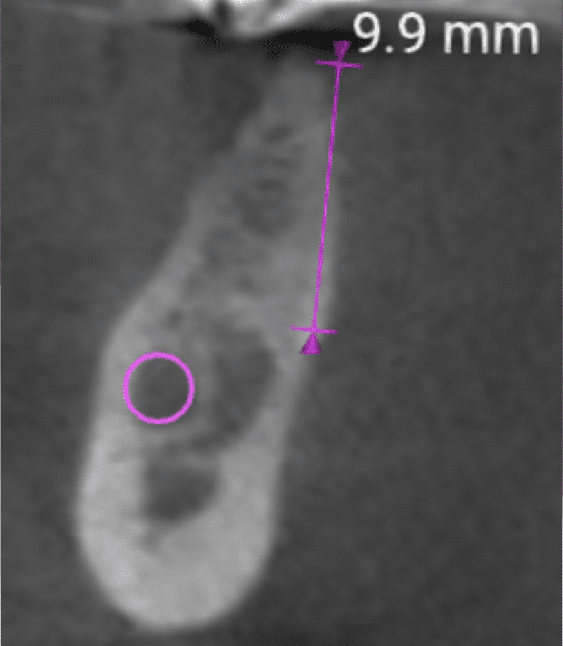 Screenshot 2026-01-13 alle 222314 TAC CBCT sezione atrofica su 45