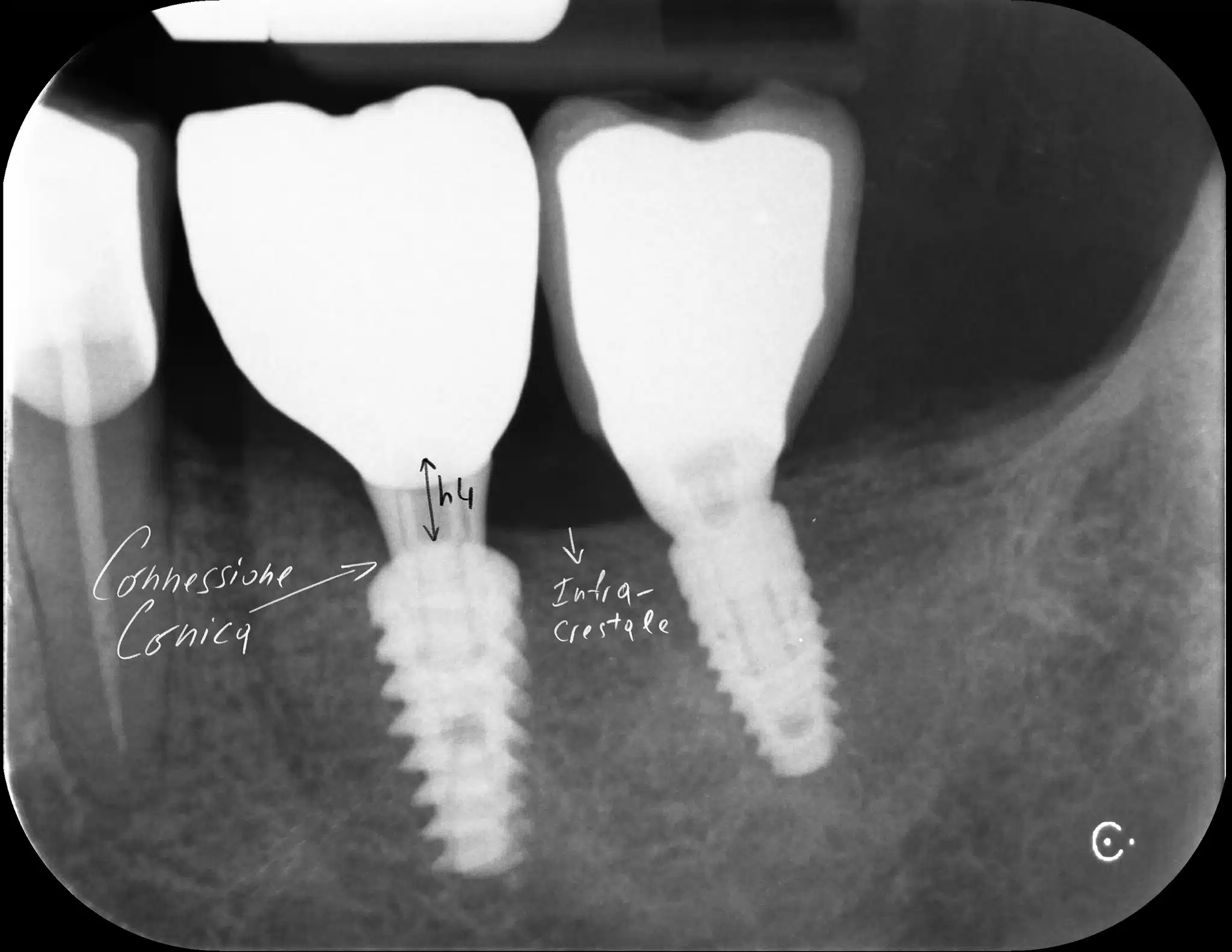 13385_Fiorini_Pietro_20250905-172800-Edit-2 - Bonebenders 13385_Fiorini_Pietro_20250905-172800-Edit-2 impianti a connessione conica kalodon newton radiografia endorale